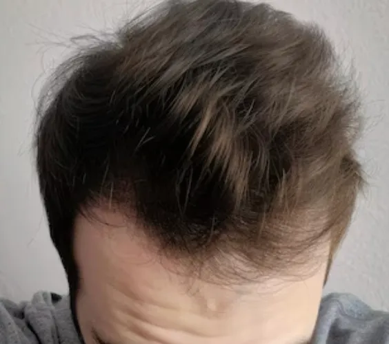 Scalp after six months
