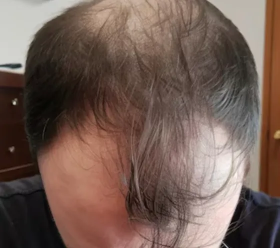 Scalp before treatment